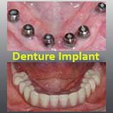 Denture Implant
