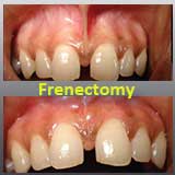 Frenectomy