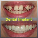 Implant