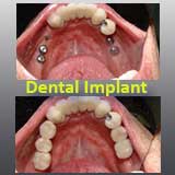 Implant