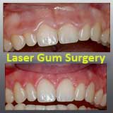 Laser Gum Surgery